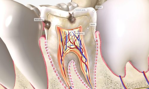 Root Canal