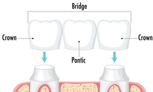 dental bridge