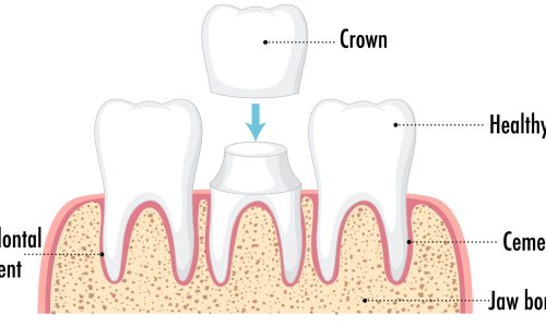 dental crown