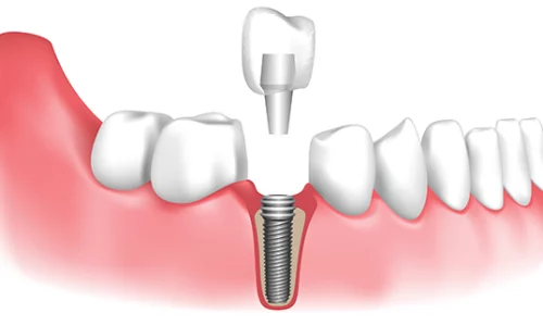 Dental Implants